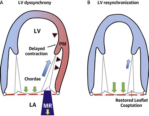 ventricular dyssynchrony